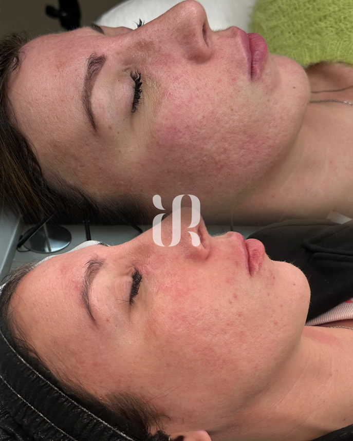 Trattamento needling prima dopo