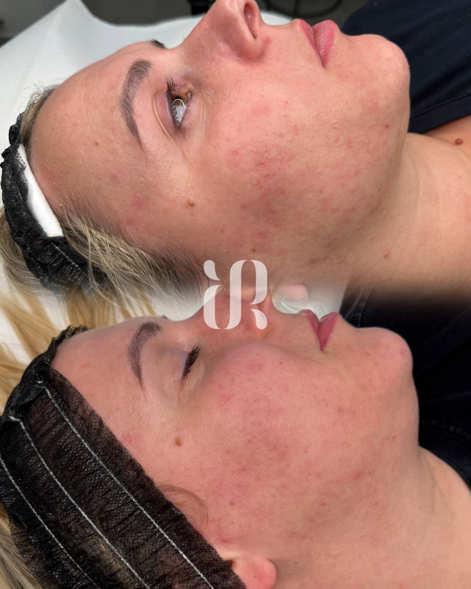 Trattamento needling a Como